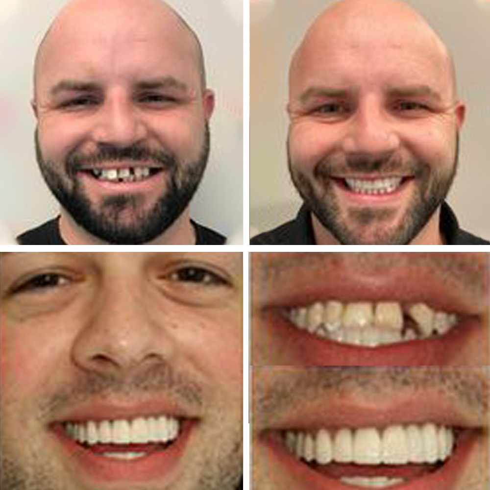 Dobshow™ 2024💫non-toxic, thermoformed dentures