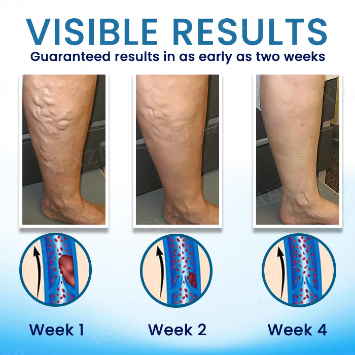 Cvreoz® Herbal Varicose Veins Treatment Spray