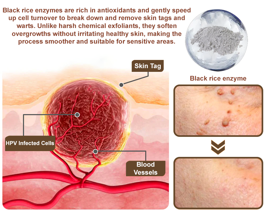 ✨ Zvoevo® Rice Bran Extract Cream 👩‍⚕️ FDA-Certified (For removing warts and skin growths, eliminating skin hyperplasia and keratin buildup, treating skin cancer, age spots, and hyperpigmentation)