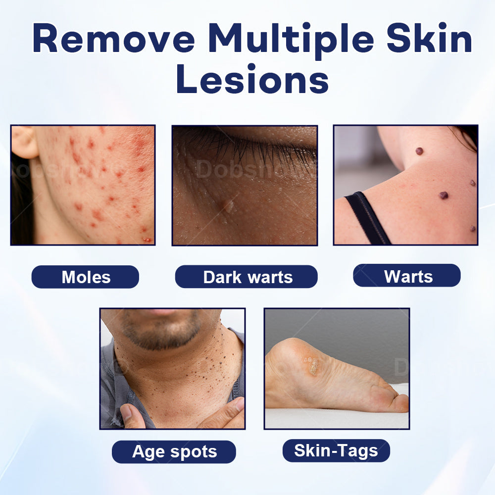 🎁𝘾𝙝𝙧𝙞𝙨𝙩𝙢𝙖𝙨 𝙎𝙖𝙡𝙚 | Cvreoz® Mole and Wart Removal Cream