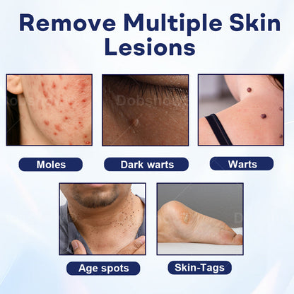🎁𝘾𝙝𝙧𝙞𝙨𝙩𝙢𝙖𝙨 𝙎𝙖𝙡𝙚 | Cvreoz® Mole and Wart Removal Cream