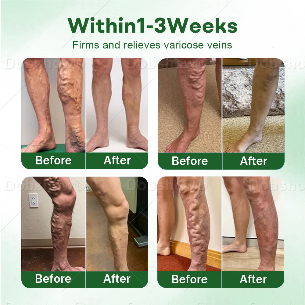 🎄𝘾𝙝𝙧𝙞𝙨𝙩𝙢𝙖𝙨 𝙎𝙖𝙡𝙚| Croaie® VeinLock Microneedle Patch