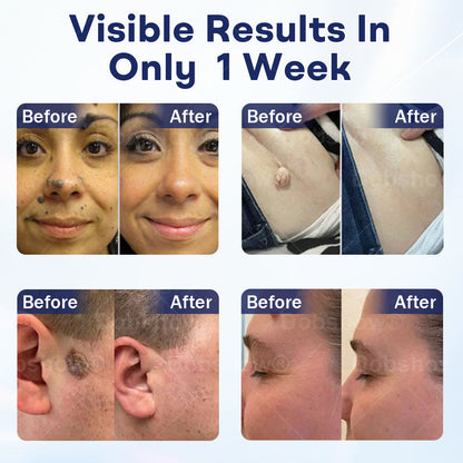 🎁𝘾𝙝𝙧𝙞𝙨𝙩𝙢𝙖𝙨 𝙎𝙖𝙡𝙚 | Cvreoz® Mole and Wart Removal Cream