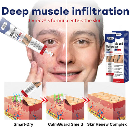 🎁𝘾𝙝𝙧𝙞𝙨𝙩𝙢𝙖𝙨 𝙎𝙖𝙡𝙚 | Cvreoz® Mole and Wart Removal Cream