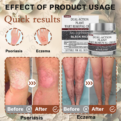 ✨ Zvoevo® Rice Bran Extract Cream 👩‍⚕️ FDA-Certified (For removing warts and skin growths, eliminating skin hyperplasia and keratin buildup, treating skin cancer, age spots, and hyperpigmentation)