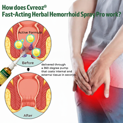 🎅𝘾𝙝𝙧𝙞𝙨𝙩𝙢𝙖𝙨 𝙎𝙖𝙡𝙚 | Cvreoz® Fast-Acting Herbal Hemorrhoid Spray Pro