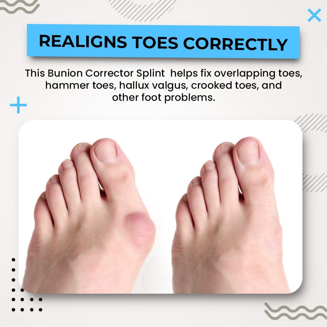 Nurbini™ 3D Bunion Splint Corrector🦶