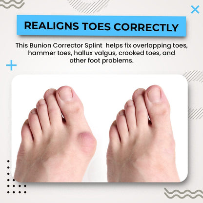 Nurbini™ 3D Bunion Splint Corrector🦶