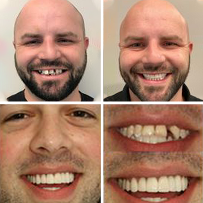 Dobshow™ 2024💫non-toxic, thermoformed dentures