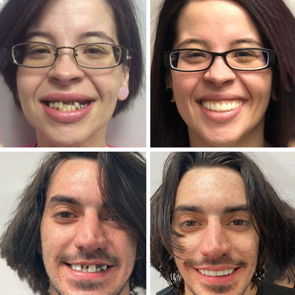 Dobshow™ 2024💫non-toxic, thermoformed dentures